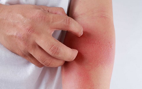 Nhận biết và kiểm soát viêm da tiếp xúc
